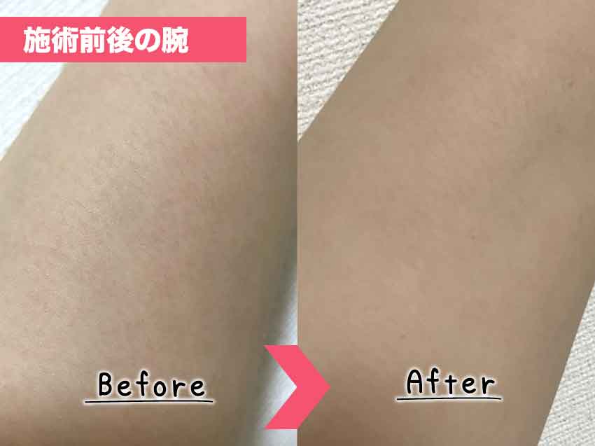 脱毛サロン脱毛ラボ全身脱毛前後の腕の写真