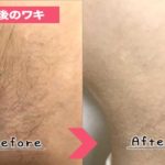 ジェイエステ（ワキ・腕・足脱毛）の写真＆評価を突撃インタビュー