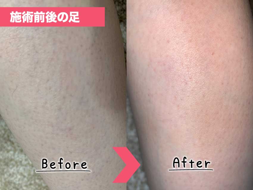 脱毛サロンキレイモ　脱毛前後の足の写真