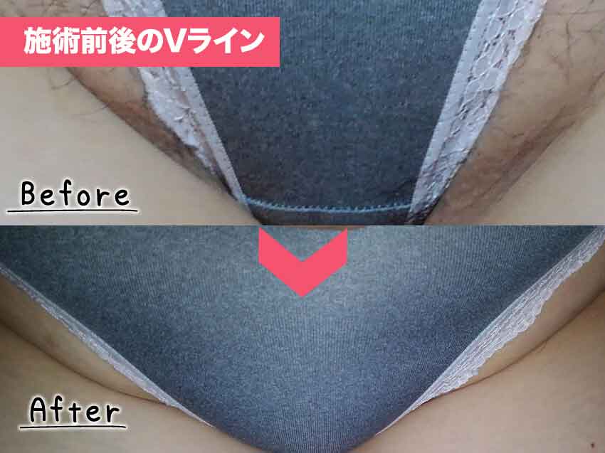 脱毛サロンミュゼ　Vライン脱毛前後の写真